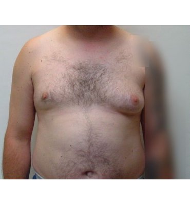 gynecomastio before